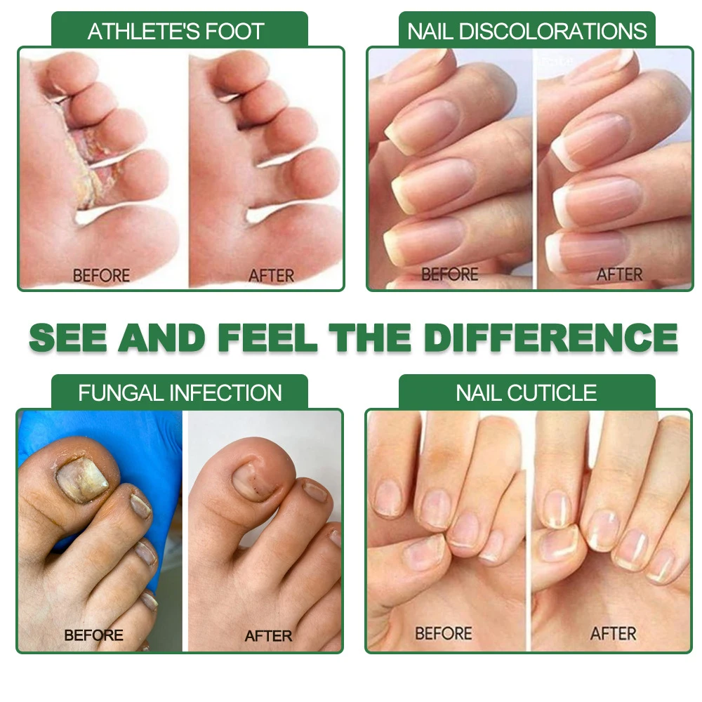 7 Days Fungal Nail Treatment Serum Foot Nail Fungus Removal Repair Gel Anti Infection Paronychia Onychomycosis Foot Nails Care 7 Days Fungal Nail Treatment Serum Foot Nail Fungus Removal Repair Gel Anti Infection Paronychia Onychomycosis Foot Nails Care - Image 2