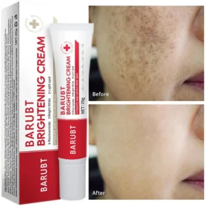 Bleaching Sommersprossen Gesichtscreme Entfernung Melasma Dunkle Flecken Korrektor Aufhellen Melanin Pigmentierung Aufhellen Anti-Aging Schönheit Pflege