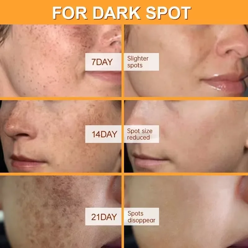 Bleaching Sommersprossen Gesichtscreme Entfernung Melasma Dunkle Flecken Korrektor Aufhellen Melanin Pigmentierung Aufhellen Anti-Aging Schönheit Pflege Bleaching Sommersprossen Gesichtscreme Entfernung Melasma Dunkle Flecken Korrektor Aufhellen Melanin Pigmentierung Aufhellen Anti-Aging Schönheit Pflege - Image 2