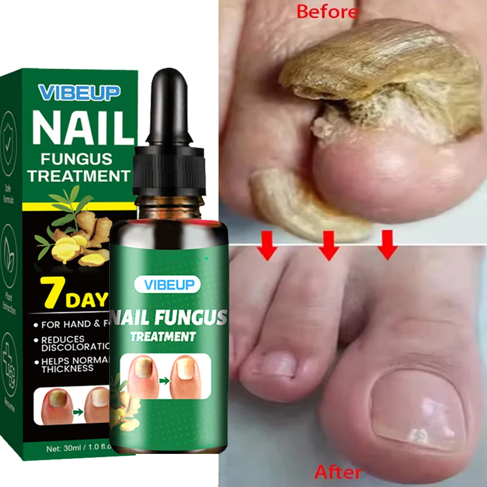 7 Days Fungal Nail Treatment Serum Foot Nail Fungus Removal Repair Gel Anti Infection Paronychia Onychomycosis Foot Nails Care 7 Days Fungal Nail Treatment Serum Foot Nail Fungus Removal Repair Gel Anti Infection Paronychia Onychomycosis Foot Nails Care