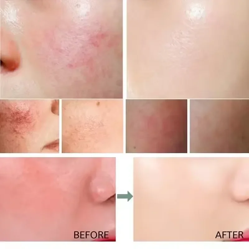 Facial Redness Repair Cream Improve Sensitive Skin Dryness Moisturizer Hydrating Sooth Lotion Removal Rosacea Korean Cosmetics Facial Redness Repair Cream Improve Sensitive Skin Dryness Moisturizer Hydrating Sooth Lotion Removal Rosacea Korean Cosmetics - Image 4