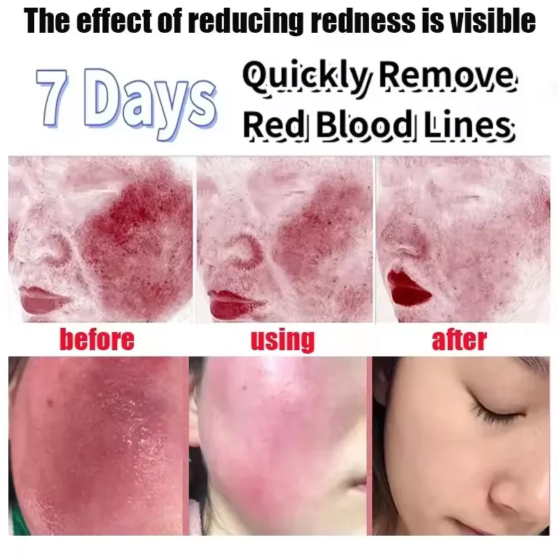 Facial Redness Repair Cream Improve Sensitive Skin Dryness Moisturizer Hydrating Sooth Lotion Removal Rosacea Korean Cosmetics Facial Redness Repair Cream Improve Sensitive Skin Dryness Moisturizer Hydrating Sooth Lotion Removal Rosacea Korean Cosmetics - Image 5