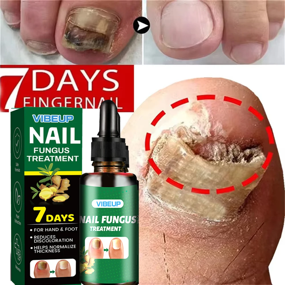 7 Days Fungal Nail Treatment Serum Foot Nail Fungus Removal Repair Gel Anti Infection Paronychia Onychomycosis Foot Nails Care 7 Days Fungal Nail Treatment Serum Foot Nail Fungus Removal Repair Gel Anti Infection Paronychia Onychomycosis Foot Nails Care - Image 3