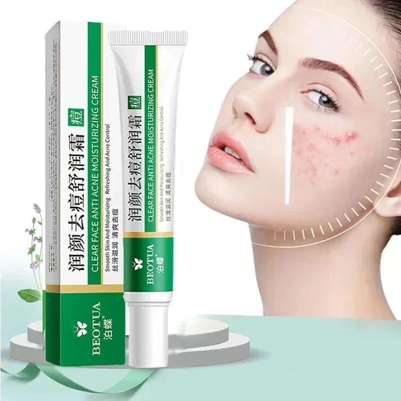 Kräuter Akne Behandlung Creme Gesicht Narbe Mitesser Entferner Reparatur Gel Öl Kontrolle Schrumpfen Poren Bleaching Hautpflege Koreanische Kosmetik Kräuter Akne Behandlung Creme Gesicht Narbe Mitesser Entferner Reparatur Gel Öl Kontrolle Schrumpfen Poren Bleaching Hautpflege Koreanische Kosmetik