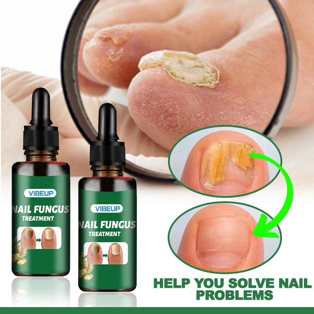 7 Days Fungal Nail Treatment Serum Foot Nail Fungus Removal Repair Gel Anti Infection Paronychia Onychomycosis Foot Nails Care 7 Days Fungal Nail Treatment Serum Foot Nail Fungus Removal Repair Gel Anti Infection Paronychia Onychomycosis Foot Nails Care - Image 6