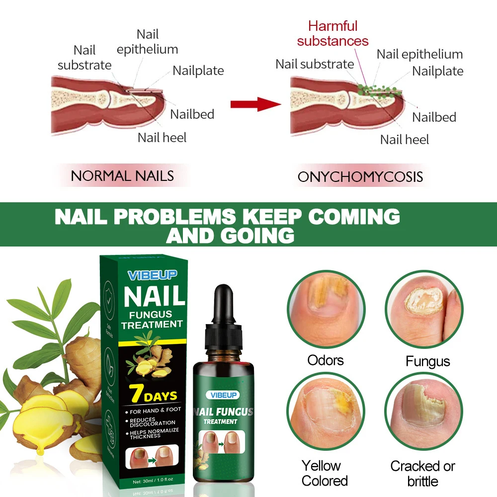 7 Days Fungal Nail Treatment Serum Foot Nail Fungus Removal Repair Gel Anti Infection Paronychia Onychomycosis Foot Nails Care 7 Days Fungal Nail Treatment Serum Foot Nail Fungus Removal Repair Gel Anti Infection Paronychia Onychomycosis Foot Nails Care - Image 5