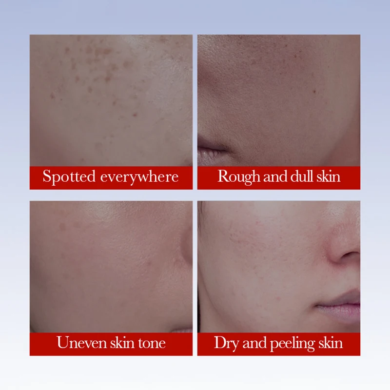 Sadoer Anti-Sommersprossen-Creme Gesichtsaufhellungscreme Fleckenentferner Anti-Aging Feuchtigkeitsspendende Sommersprossen-Entfernungs-Gesichtscreme Hautpflege Sadoer Anti-Sommersprossen-Creme Gesichtsaufhellungscreme Fleckenentferner Anti-Aging Feuchtigkeitsspendende Sommersprossen-Entfernungs-Gesichtscreme Hautpflege - Image 5