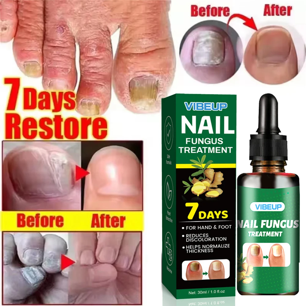7 Days Fungal Nail Treatment Serum Foot Nail Fungus Removal Repair Gel Anti Infection Paronychia Onychomycosis Foot Nails Care 7 Days Fungal Nail Treatment Serum Foot Nail Fungus Removal Repair Gel Anti Infection Paronychia Onychomycosis Foot Nails Care - Image 4